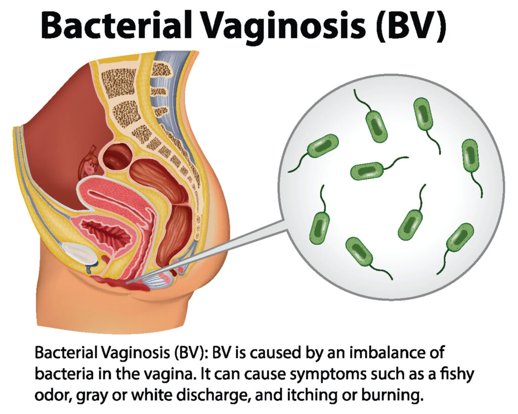 Bacterial Vaginosis (BV) that smells