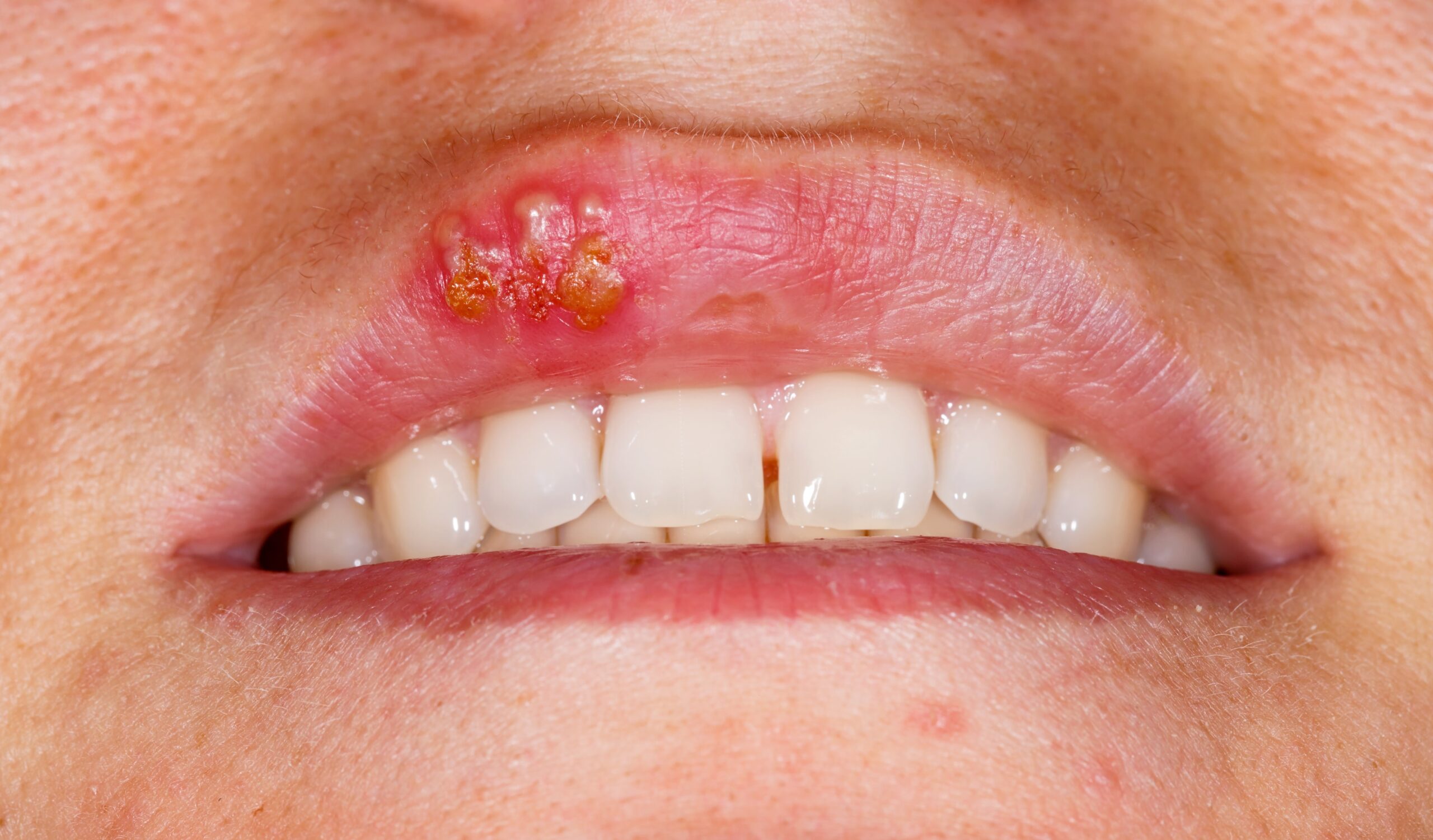 oral herpes