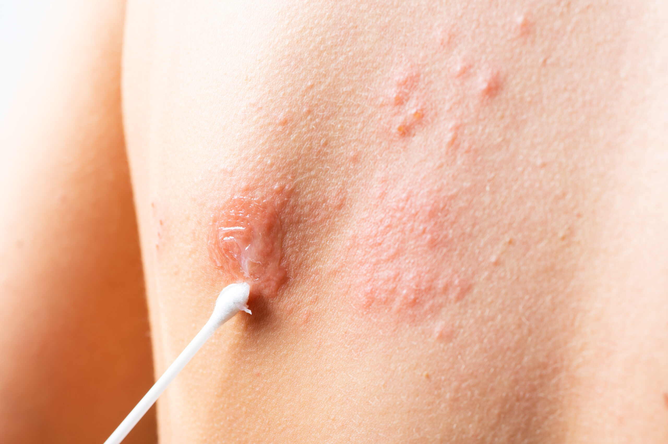 herpes on buttocks